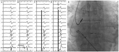 Novel Wide-Band Dielectric Imaging System Guided Lead Deployment for His Bundle Pacing: A Feasibility Study